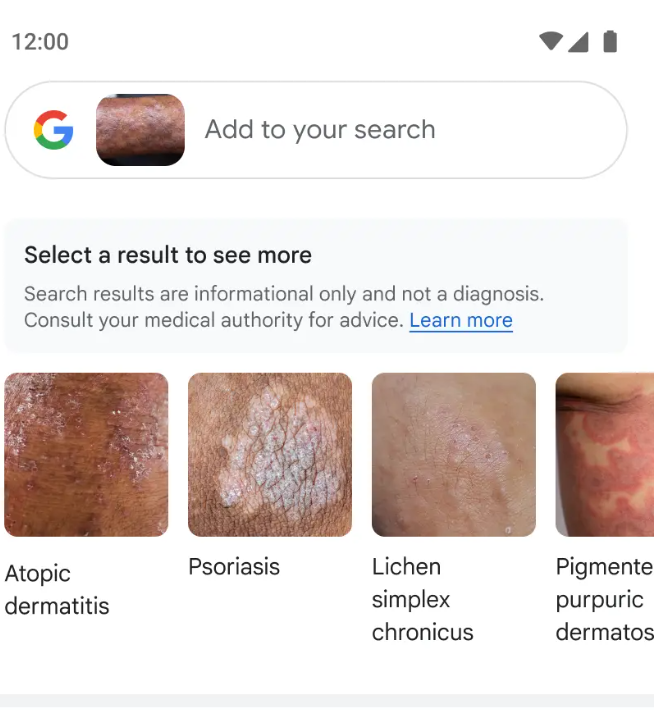 google Lens可以帮助人们比对皮肤健康状况